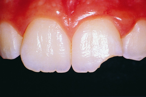 Traitement des dents ébréchées